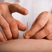 Anxiety and Acupuncture