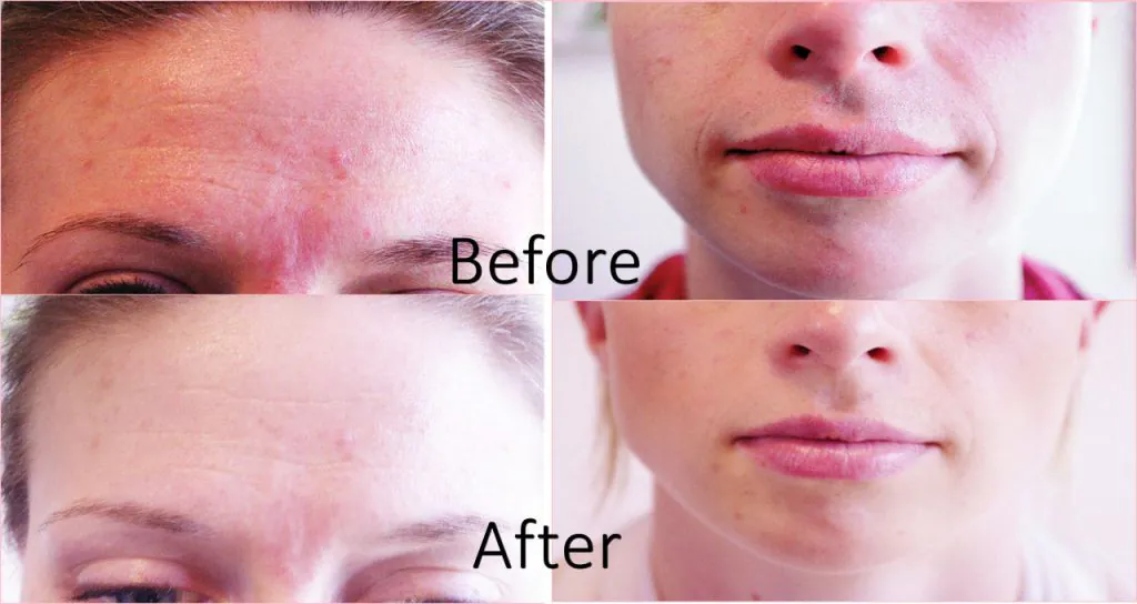 forehead-mouth_before-after-1024x544